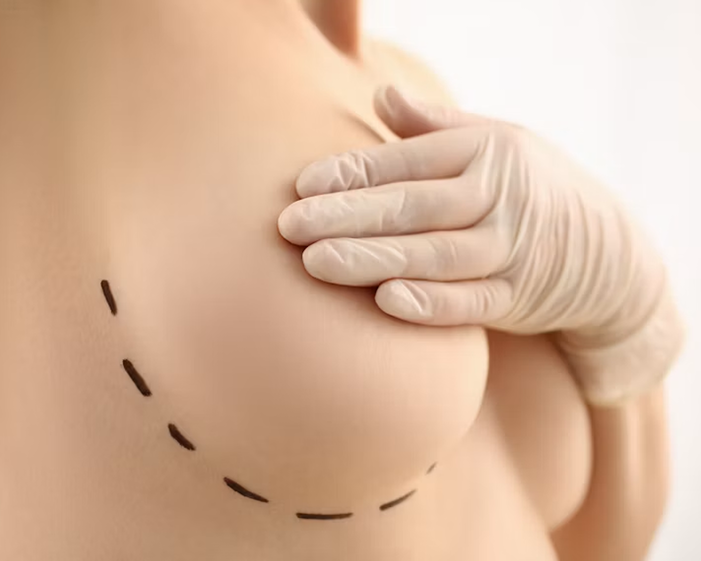 Surgeon consulting a patient about Breast Lift